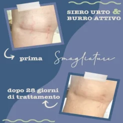 Siero Urto Smagliature